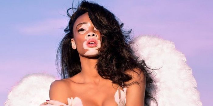 Vitiligo hastası manken güzelliğiyle büyülüyor