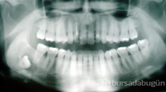 İnsanda bulunan 10 körelmiş organ