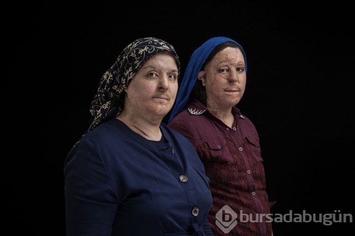 Asidin yaktığı hayatlar