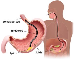Kötü beslenme reflüyü tetikliyor