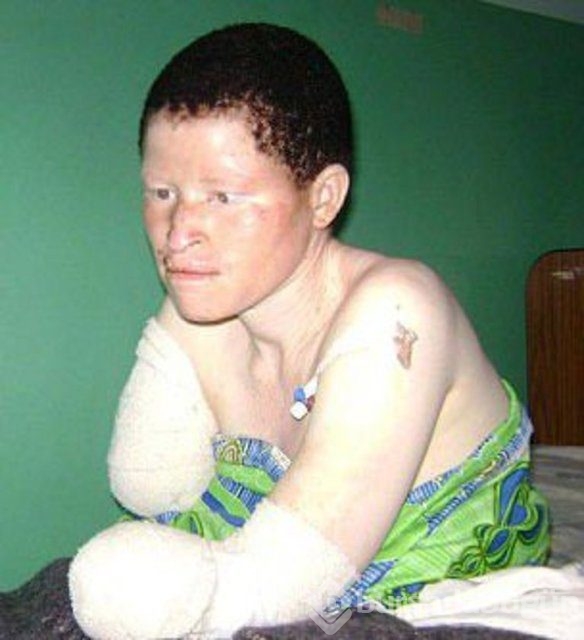 Tanzanya'da albino cinayeti
