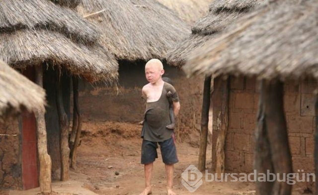 Tanzanya'da albino cinayeti
