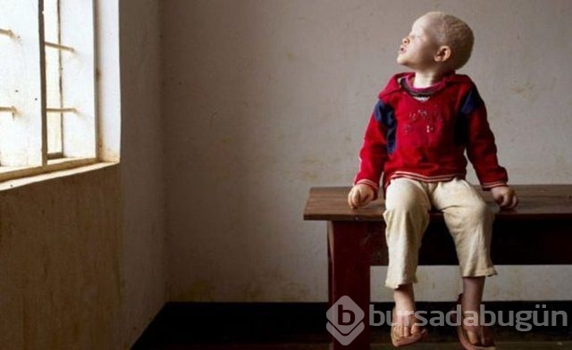 Tanzanya'da albino cinayeti

