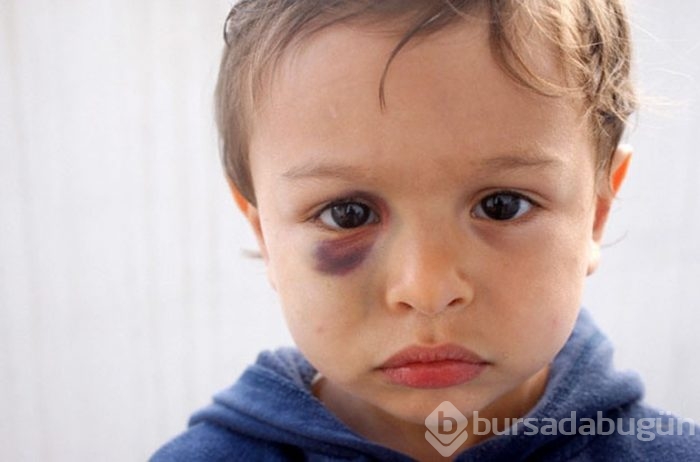Çocuğunuzda sebepsiz morluklar varsa dikkat!