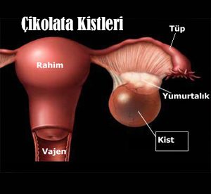 Çikolata kisti kadınları süründürüyor