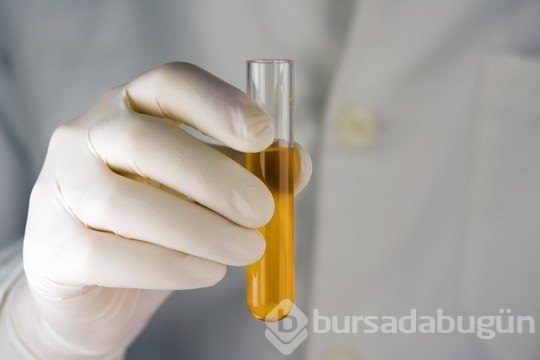 Değişen idrar rengi o hastalığın habercisi!