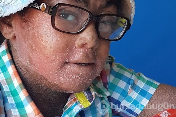 Cildi öyle sert ki üç yıldır gözlerini kapatamıyor