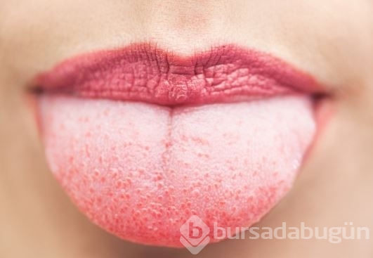 Diline bak hastalığını öğren