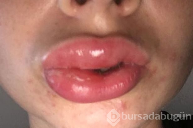 Dişini beyazlatmak isterken bu hale geldi