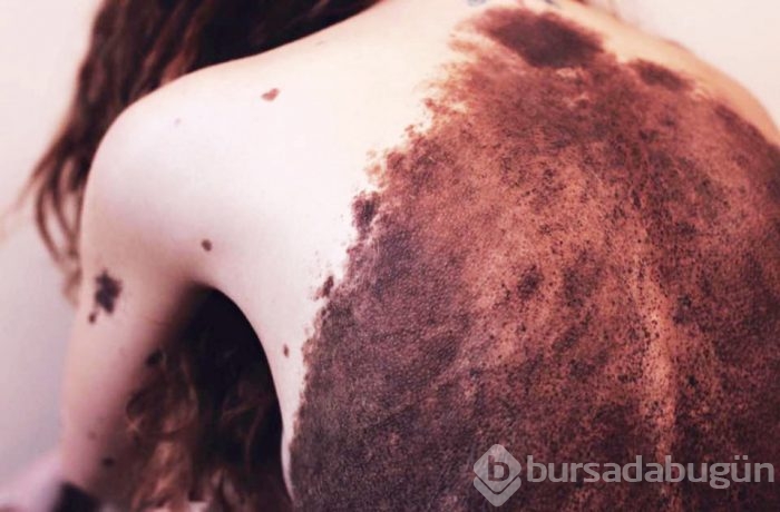 Tüm vücudu benlerle kaplı...Sosyal medyayı sallayan Dalmaçyalı kadın