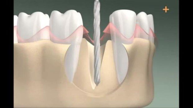 Diş implantı böyle yapılıyor