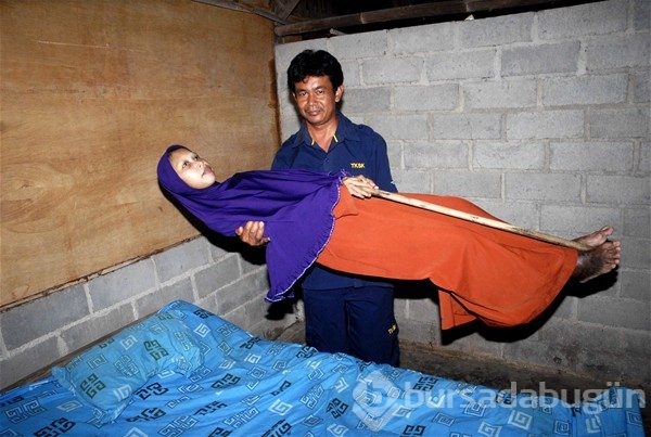 Dünyanın en tuhaf hastalıkları