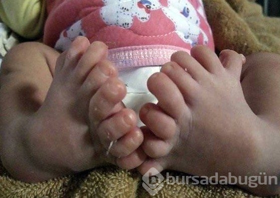 Dünyanın en tuhaf hastalıkları