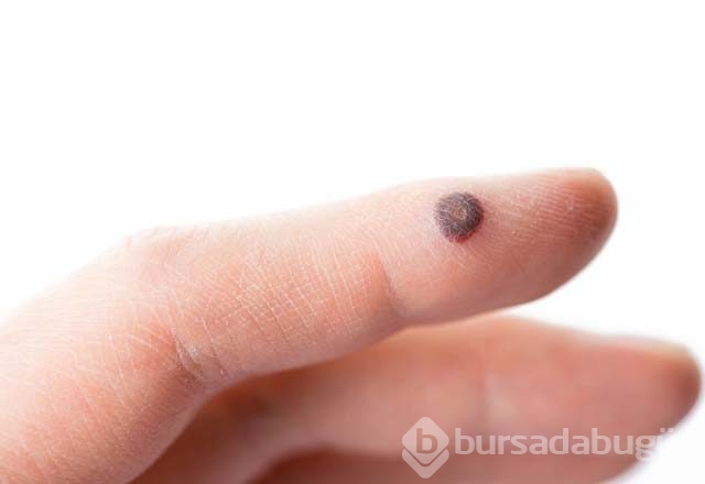 Siğiller için ev yapımı doğal tedaviler