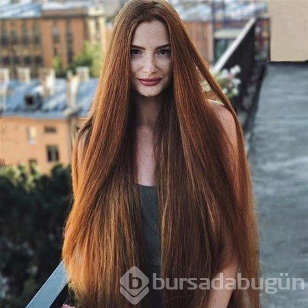 Yıllarca kel kalan kızın son hali!