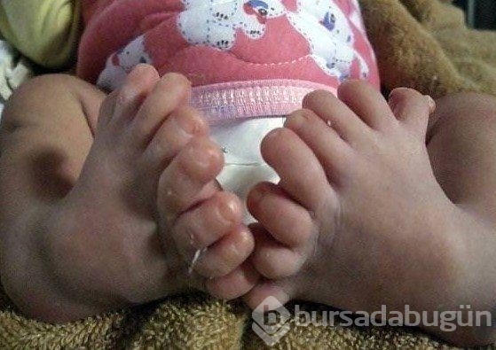 Dünyanın en tuhaf hastalıkları