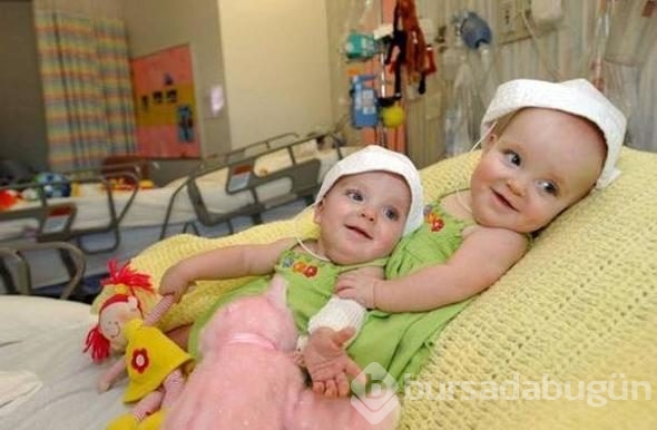 16 yıl önce herkes onları konuşmuştu! Yapışık ikizlerin son halleri
