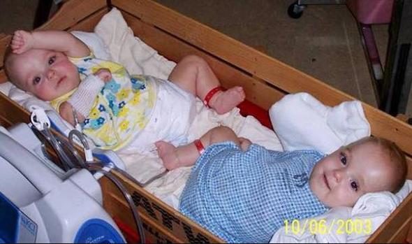 16 yıl önce herkes onları konuşmuştu! Yapışık ikizlerin son halleri
