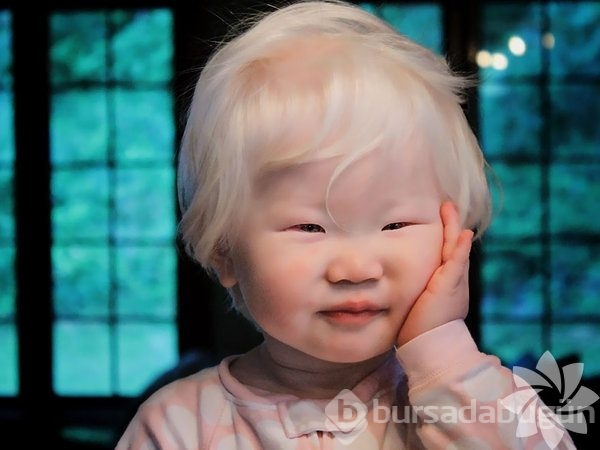 Albino insanlar
