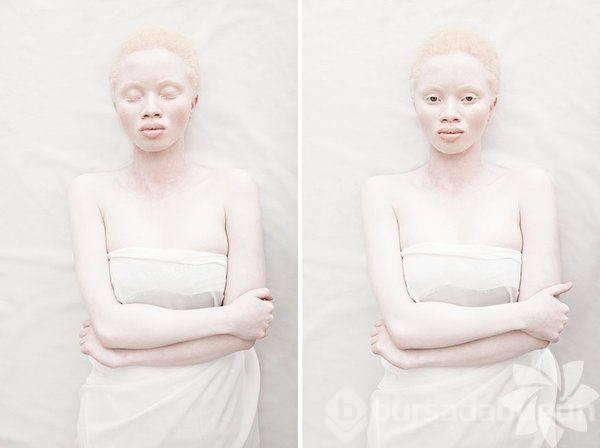 Albino insanlar
