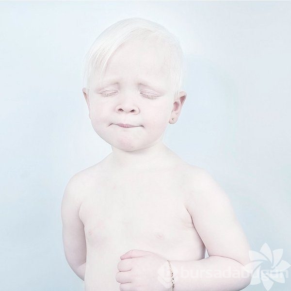 Albino insanlar
