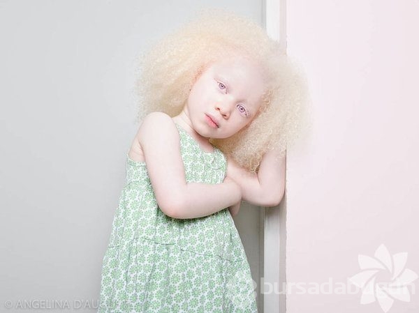 Albino insanlar
