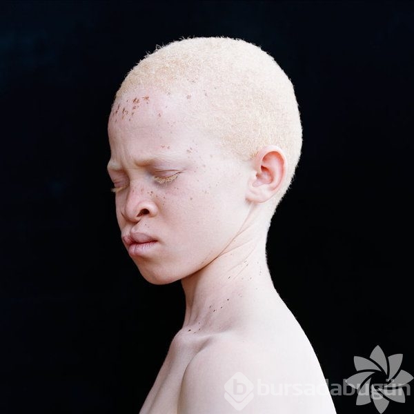 Albino insanlar
