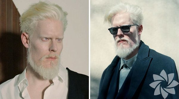 Albino insanlar
