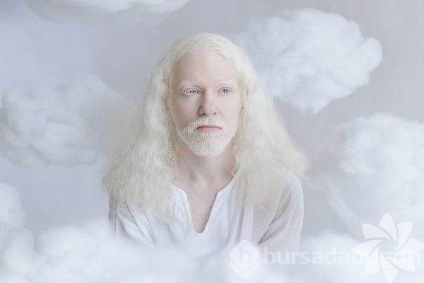 Albino insanlar

