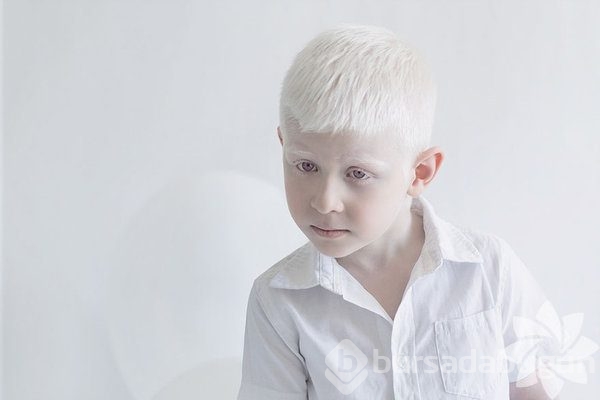 Albino insanlar
