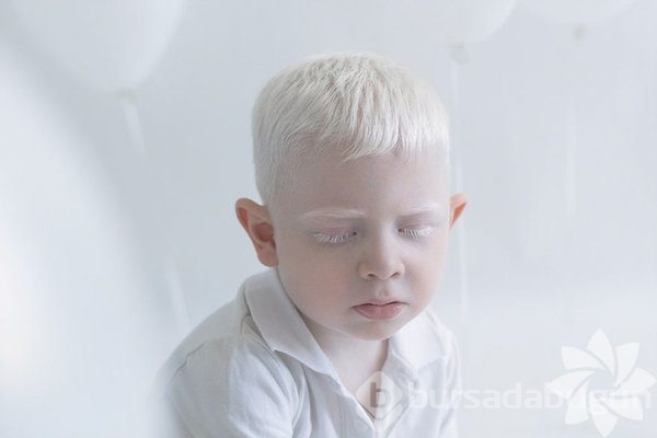 Albino insanlar
