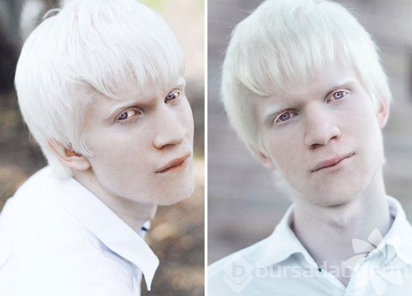Albino insanlar
