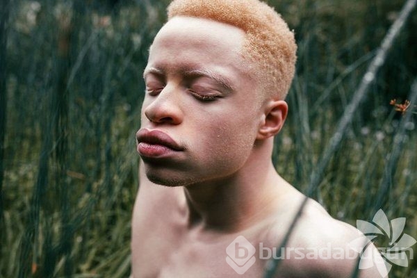 Albino insanlar
