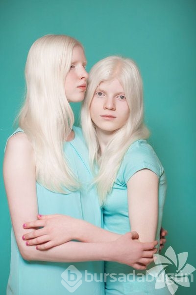 Albino insanlar
