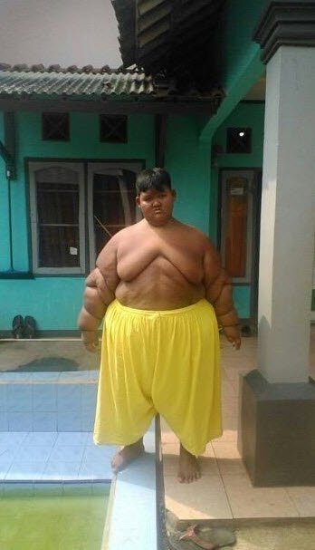 Dünyanın en şişman çocuğuydu...Tam 83 kilo verdi!