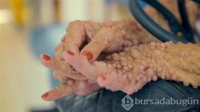 Dikkat! Yıllardır nezle olduğunu sanıyordu gerçek çok farklı çıktı!