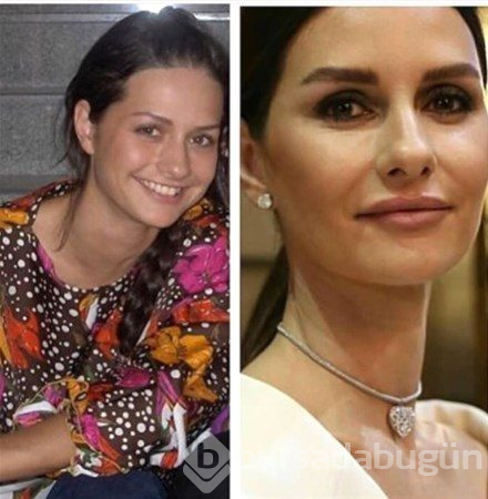 Estetikle başka birine dönüşen Türk ünlüler