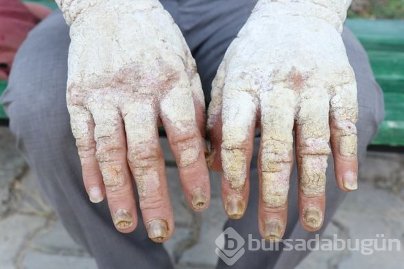 Sedef hastalığı hayatı zindan etti! Onu gören korkup kaçıyor