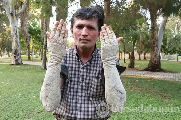 Sedef hastalığı hayatı zindan etti! Onu gören korkup kaçıyor