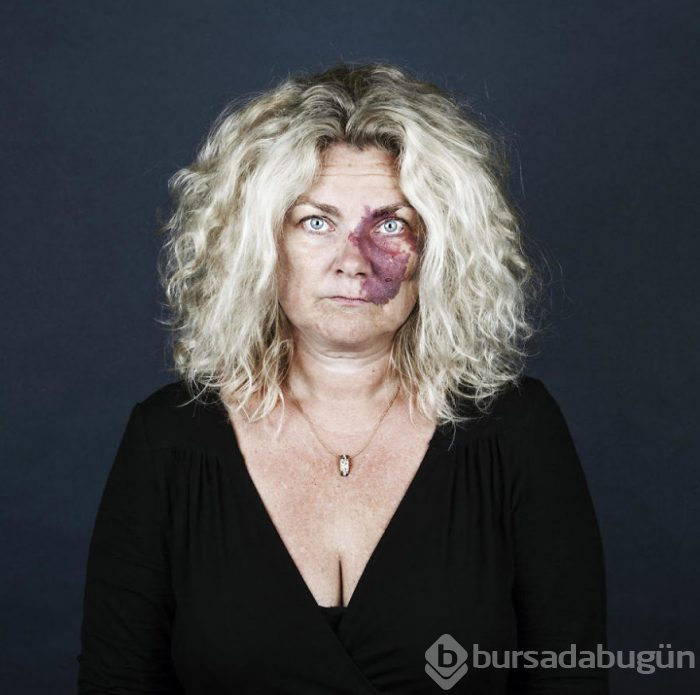 Harika bir fotoğraf sergisi: Doğum lekelerinin ardını görmek