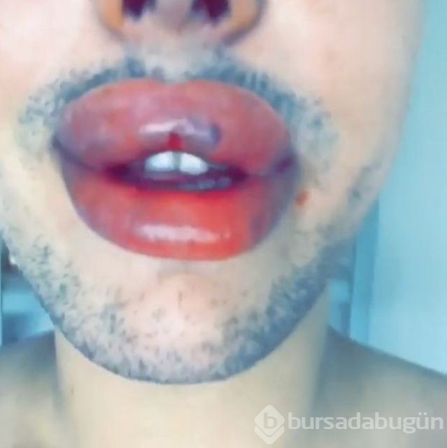 Estetik bağımlılığı bunu da yaptırdı!
