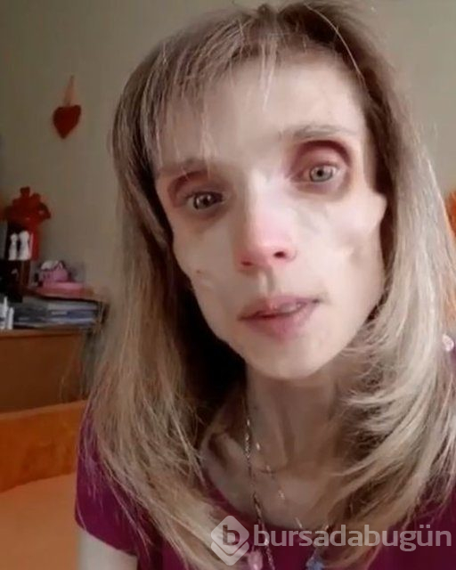 Anoreksiya hastası Kristina Karyagina 17 kilo
