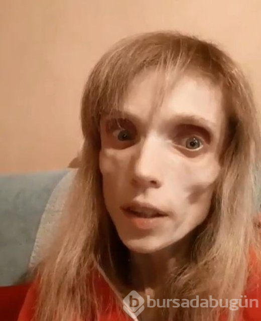 Anoreksiya hastası Kristina Karyagina 17 kilo
