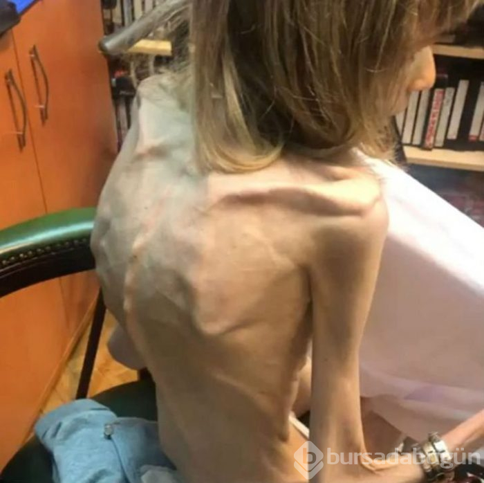 Tedavi olmazsa ölecek! Sadece elma ve muzla beslenerek 17 kiloya düştü

