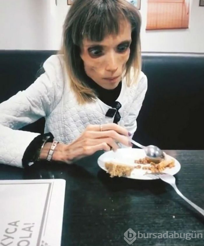 Tedavi olmazsa ölecek! Sadece elma ve muzla beslenerek 17 kiloya düştü
