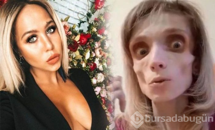 Tedavi olmazsa ölecek! Sadece elma ve muzla beslenerek 17 kiloya düştü
