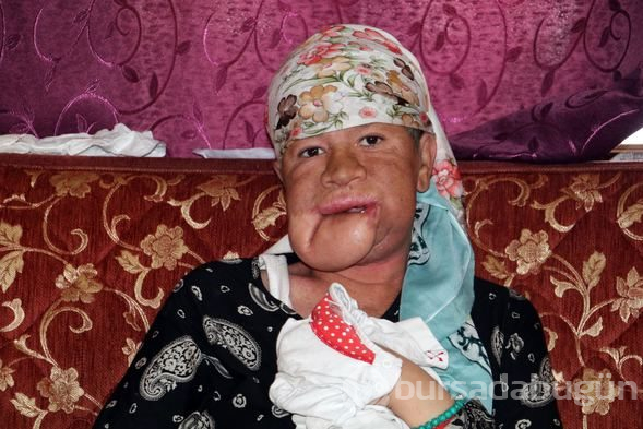 Çenesinde çıkan sivilceyi önemsemedi, hayatı karardı
