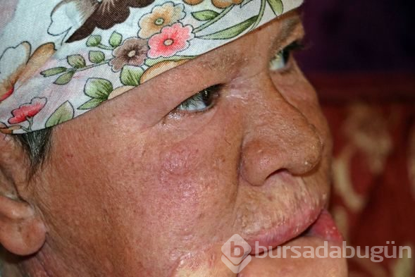 Çenesinde çıkan sivilceyi önemsemedi, hayatı karardı
