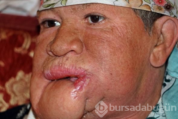 Çenesinde çıkan sivilceyi önemsemedi, hayatı karardı
