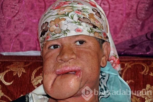 Çenesinde çıkan sivilceyi önemsemedi, hayatı karardı
